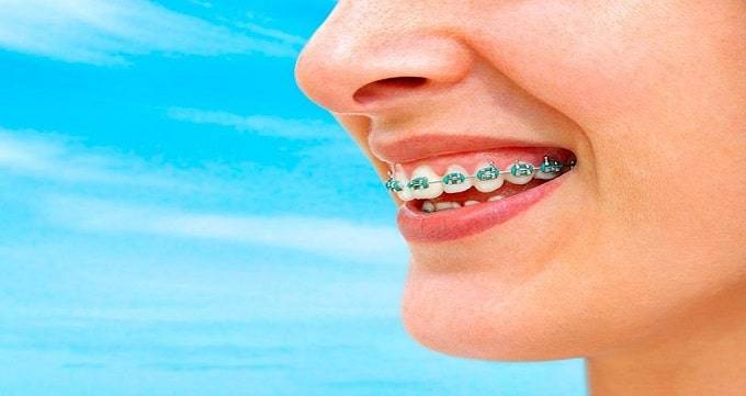 ارتودنسی دندان ها چگونه انجام می شوند؟