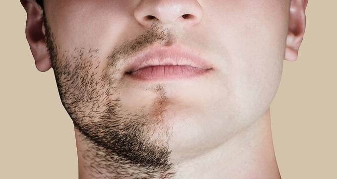 دلایل ریزش مو در ناحیه ریش