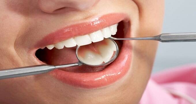 انواع کامپوزیت دندان 