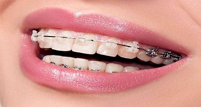 خدمات ترمیمی و زیبایی دندان