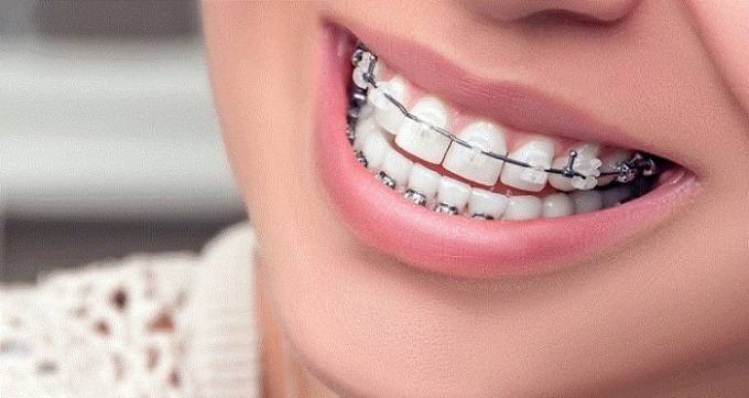 فواید ارتودنسی دندان