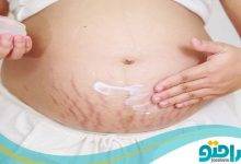 10 روش خانگی درمان ترک های پوستی