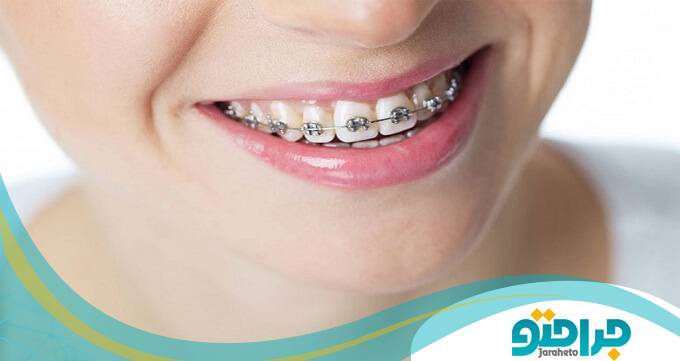 ارتودنسی دندان به چند روش انجام می شود؟