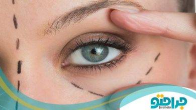 بهترین جراح بلفاروپلاستی در کرمانشاه