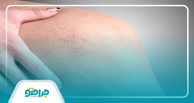 علائم واریس