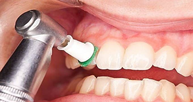 روش های جدید بلیچینگ دندان