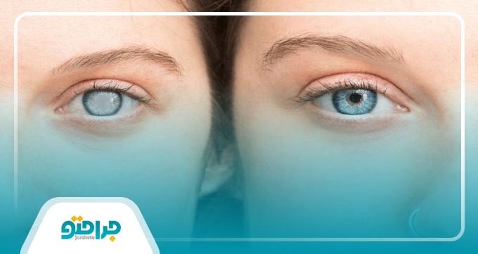 ویژگی های بهترین جراح آب مروارید در تهران