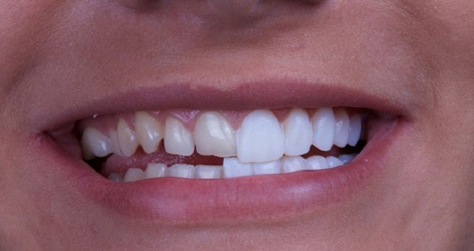 آیا کامپوزیت برای ترمیم دندان های خراب مناسب است؟