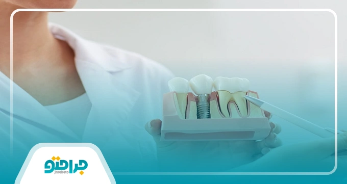مهم ترین مزایای ایمپلنت دندان