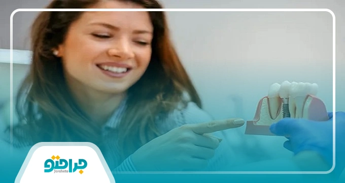 مدت زمان پروسه ایمپلنت دندان