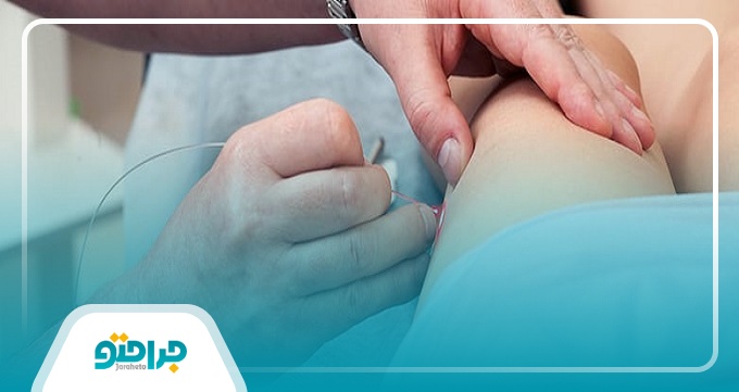 راه های مناسب برای پیشگیری از بیماری واریس