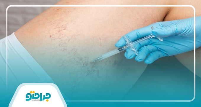 اقدامات خود مراقبتی برای درمان واریس