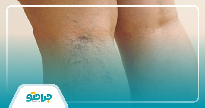 علائم ابتلا به بیماری واریس کدام است؟
