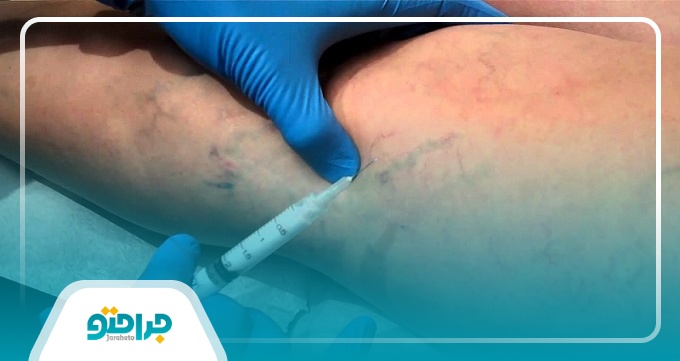 انواع واریس