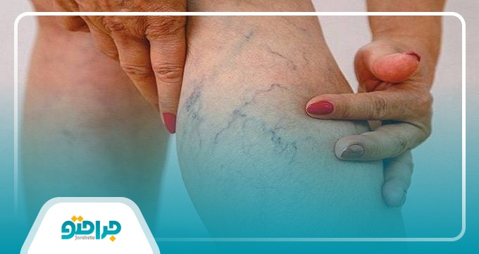 علائم واریس