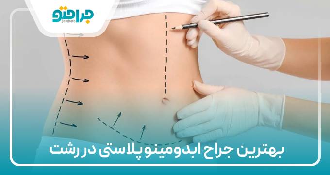 بهترین جراح ابدومینوپلاستی در رشت