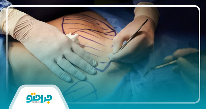 توصیه هایی برای انتخاب بهترین جراح ابدومینوپلاستی در ایران