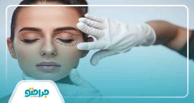 اقدامات پس از جراحی بلفاروپلاستی