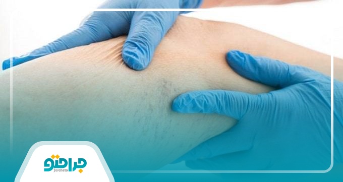 درمان خانگی واریس پا