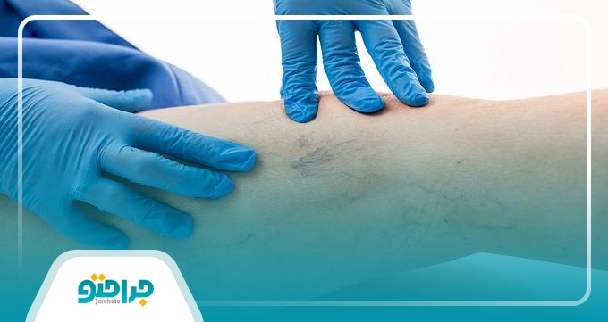 علت واریس پا چیست؟