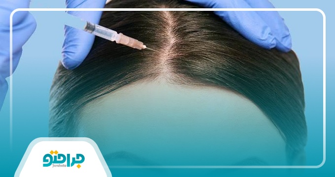 تفاوت ریزش مو در زنان و مردان