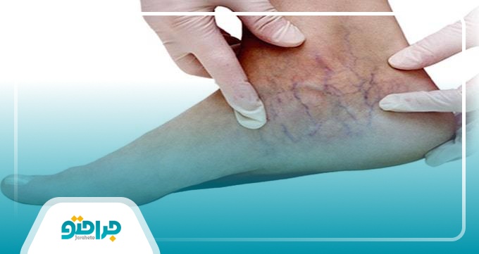 چه کسانی به واریس مبتلا می شوند؟