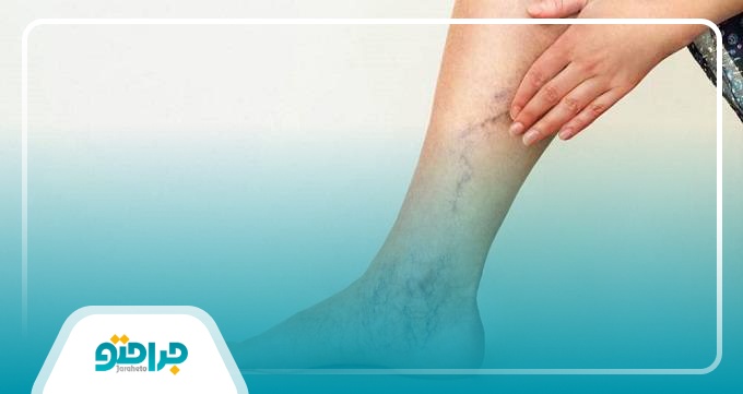 علائم واریس