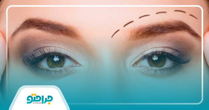 ماندگاری لیفت ابرو تا چه مدت است؟