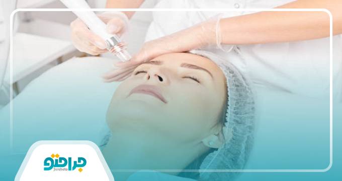 ماندگاری لیفت صورت چقدر است؟