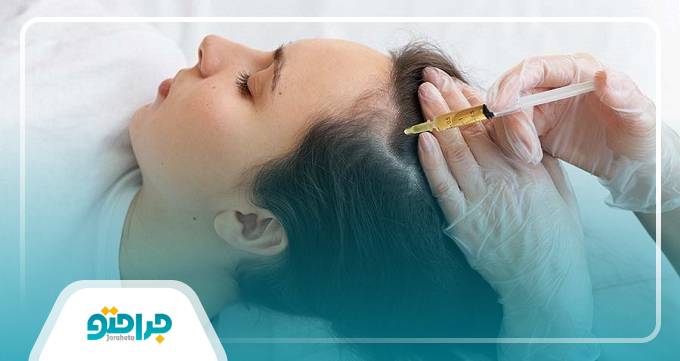 چگونگی انجام مزوتراپی مو