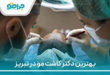 بهترین دکتر کاشت مو در تبریز
