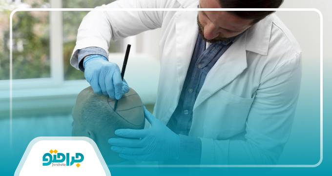 روش های کاشت مو توسط بهترین دکتر کاشت مو در تبریز