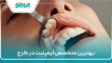 بهترین متخصص ایمپلنت در کرج