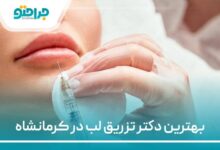 بهترین دکتر تزریق لب در کرمانشاه