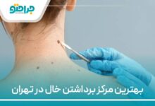 بهترین مرکز برداشتن خال در تهران