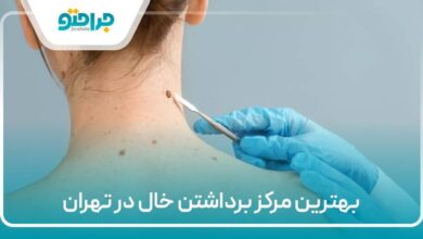 بهترین مرکز برداشتن خال در تهران