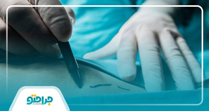 انواع روش های پیکرتراشی