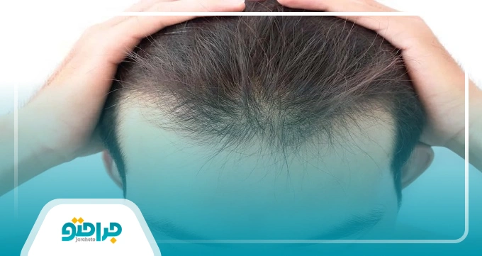 بهترین دکتر کاشت مو در جردن چه ویژگی هایی دارد؟
