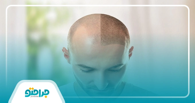 کاشت مو برای چه کسانی مناسب نیست؟