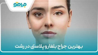 بهترین جراح بلفاروپلاستی در رشت