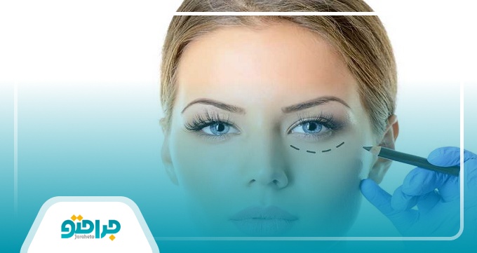 کاندیدای مناسب جراحی پلک (بلفاروپلاستی) چه افرادی هستند؟