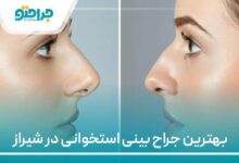 بهترین جراح بینی استخوانی در شیراز