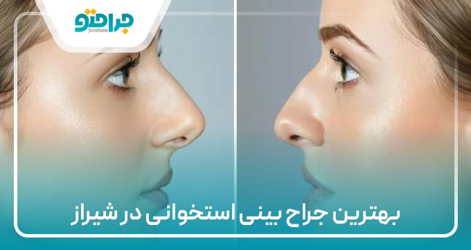بهترین جراح بینی استخوانی در شیراز