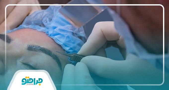 مراقبت های توصیه شده توسط بهترین دکتر کاشت ابرو در چیتگر