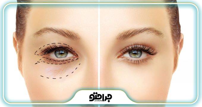 هزینه جراحی پلک توسط بهترین متخصص بلفاروپلاستی در تهران چقدر است؟