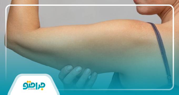 راهنمای انتخاب بهترین دکتر لیپوماتیک بازو در تهران