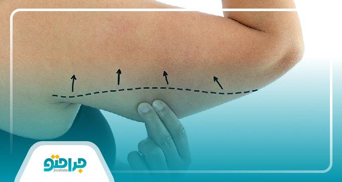 خدمات بهترین دکتر لیپوماتیک بازو