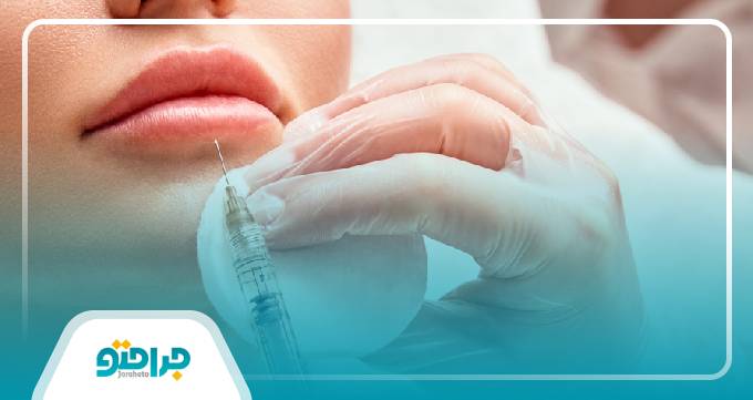 جدیدترین روش‌های تزریق ژل در لاهیجان