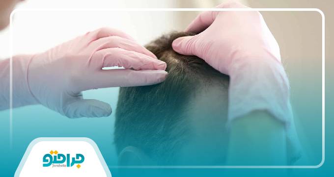 نکات مهم قبل از شروع درمان ریزش مو