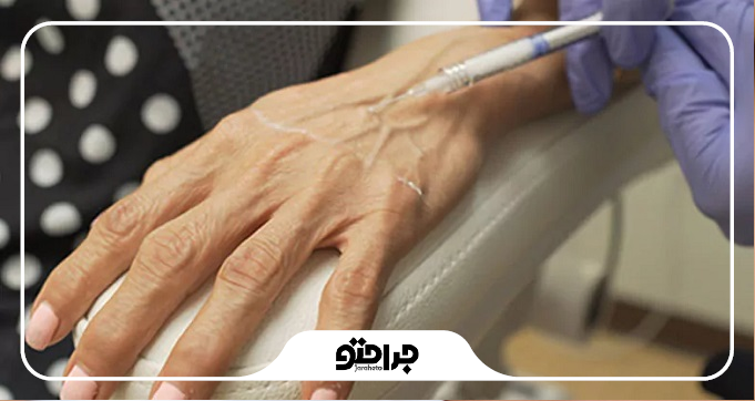 چه افرادی کاندید مناسب برای فیلربادی هستند؟